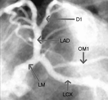 Selective injection image of the left coronary art