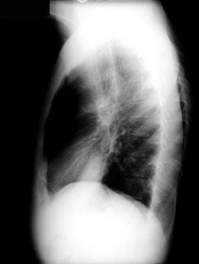 Lateral chest radiograph (same patient as in the p