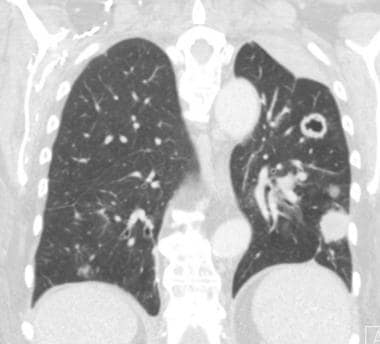 Coronal CT image in a patient with squamous cell c