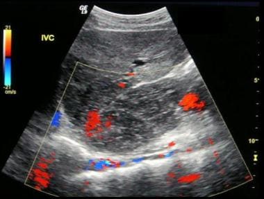 Budd-Chiari syndrome: The third of six ultrasound 