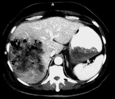 CT scan of pyogenic liver abscess. Image courtesy 