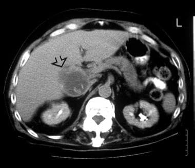 A transaxial enhanced CT scan in a 60-year-old man