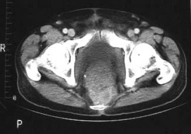 CT scan demonstrating presacral recurrence of a tu