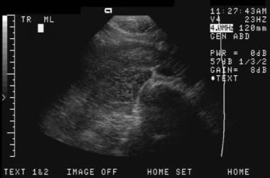 Transverse slightly oblique ultrasonogram of the r