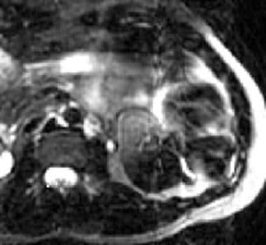 T2-weighted magnetic resonance image (MRI) of the 
