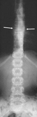 Anteroposterior radiograph of the dorsal spine in 