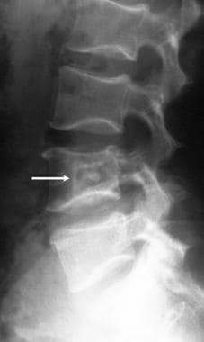 Lateral view of the lumbar spine in a 52-year-old 