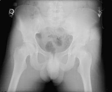 Iliac wing fracture as seen on an anteroposterior 