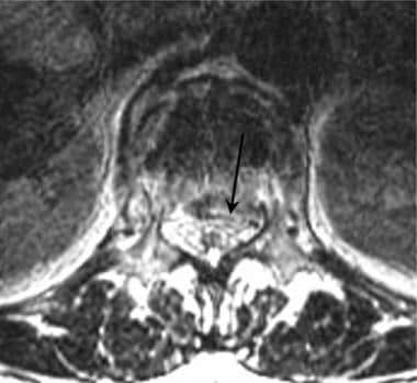 Lumbar spine trauma. Axial T2-weighted MRI image i