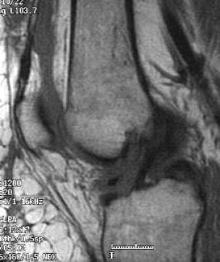 Partial-volume inclusion of the lateral femoral co