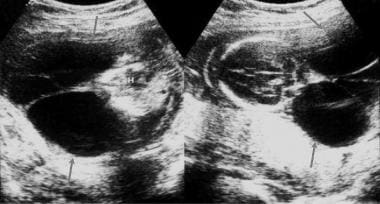 Ultrasonograms show large posterior cystic hygroma