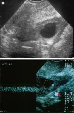 Transvaginal and color Doppler ultrasonograms of s
