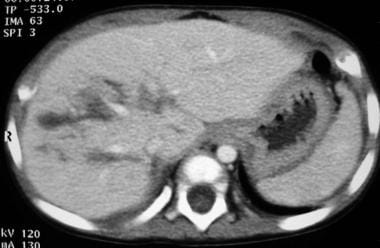 Liver laceration. Enhanced CT scan of the abdomen 
