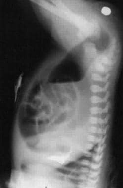 Lateral inverted abdominal radiograph in a baby wi
