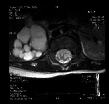 A T2-weighted MRI scan demonstrates multiple cysts