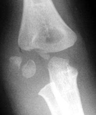 Displaced lateral condyle fracture. Anteroposterio