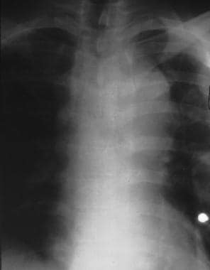 Aorta, trauma. Chest radiograph shows a circumfere