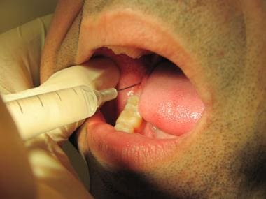 Mandibular nerve dental surgery