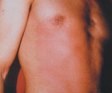 Early erythema in the frontal and antelateral righ