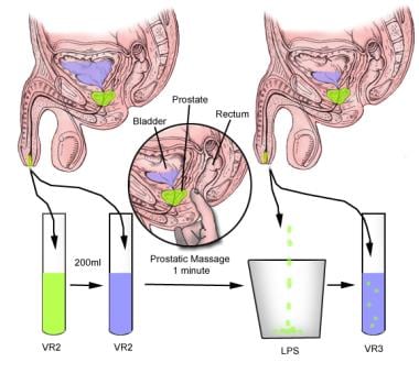 prostatitis massage treatment