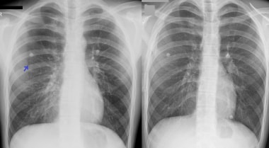 Pneumothorax chest tube.