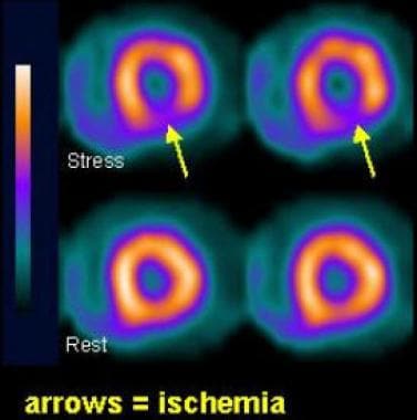 SPECT imaging performed after stress. The upper ro