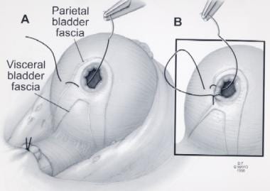 Bladder neck reconstruction. (A) 3-0 poliglecapron
