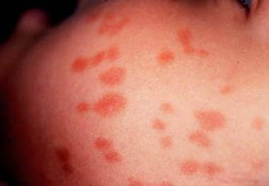 Urticaria pigmentosa lesions on the face of a chil