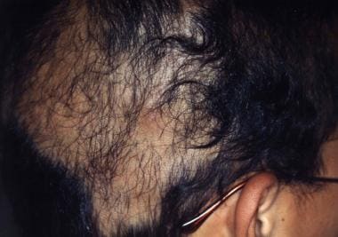 Geometric patch of incomplete alopecia in teenage 