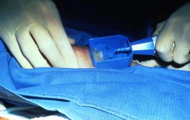Davol dermatome in use. 