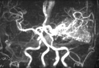 Magnetic resonance angiography showing a left medi