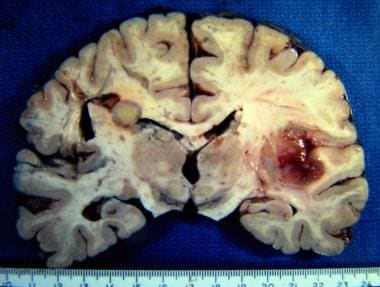Tuberculoma is the round gray mass in the left cor