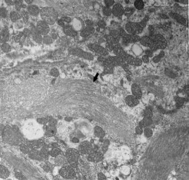 Electron micrograph showing characteristic 15-to18
