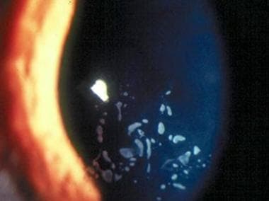 epithelial basement membrane dystrophy