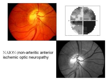 Nonarteritic anterior ischemic optic neuropathy. 