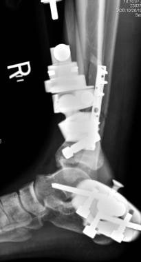 Alignment in lateral view of pilon fracture, stabi