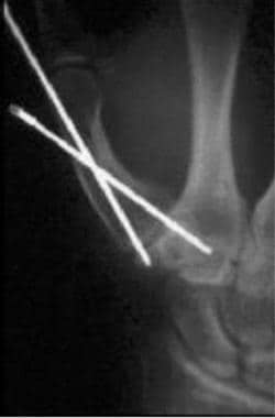 Percutaneous pinning of a Bennett fracture. 