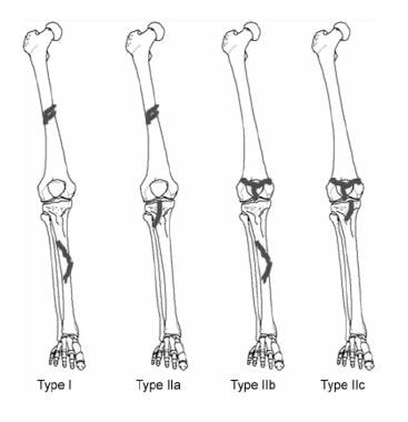 floating kneecap in humans