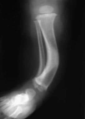 Anteroposterior radiograph of a 1-year-old child w