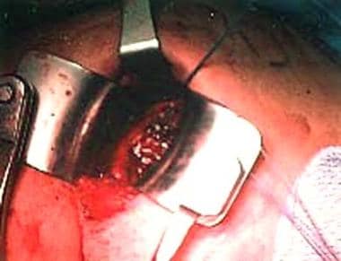Open approach via axillary incision. Self-retainin