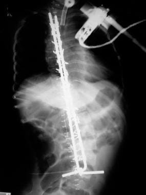 Spinal muscle atrophy. Immediate postoperative ant