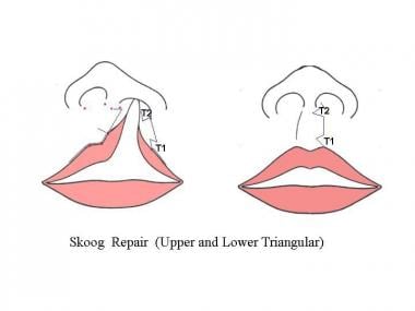 Skoog repair. The medial lip element is lengthened