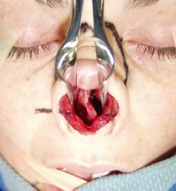 Example of surgical exposure of middle vault regio