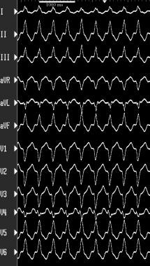 Supraventricular tachycardia with aberrancy. This 
