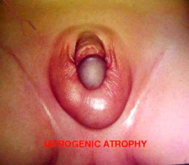 Iatrogenic cryptorchid testis in child. Taking car