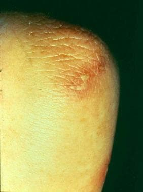 Disseminated gonococcemia, acral pustules. 