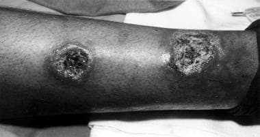 Cutaneous leishmaniasis with sporotrichotic spread