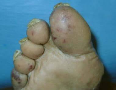 Embolic lesions in patient with Staphylococcus aur