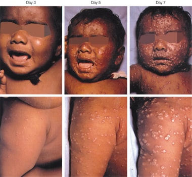 Smallpox rash at days 3, 5, and 7 of evolution. Le