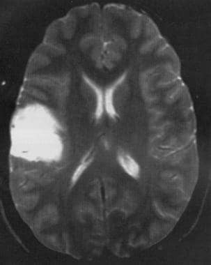 轴位t2加权MRI显示低级别星形细胞瘤